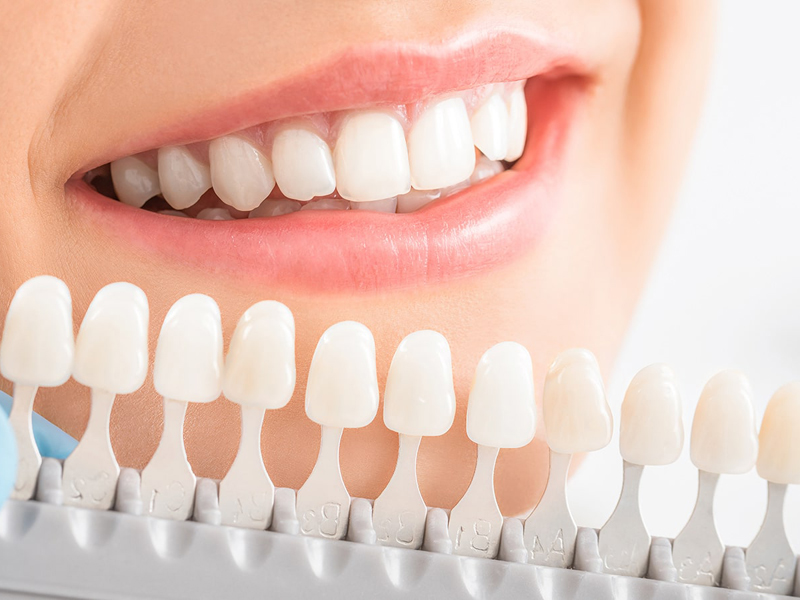 Sbiancamento dentale